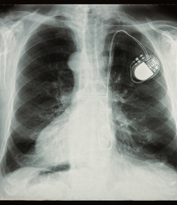 x-ray image showing an implanted pace maker.