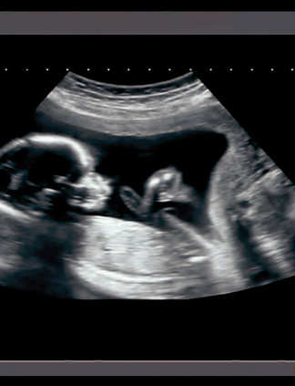 Ultrasound image of an unborn baby.