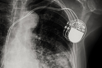 X-ray of implanted pacemaker.