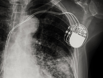 X-ray of implanted pacemaker.